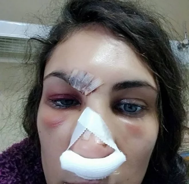 Σοκ! Στο νοσοκομείο με μώλωπες στο πρόσωπο γνωστό μοντέλο (εικόνες)